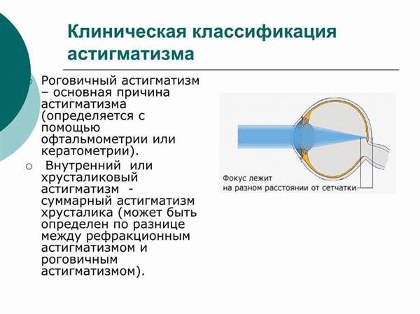 Миопия и армия: взаимосвязь и влияние на призыв